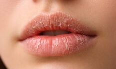 Bibir Kering saat Puasa Bikin Nggak Nyaman, Ini Tips Ampuhnya